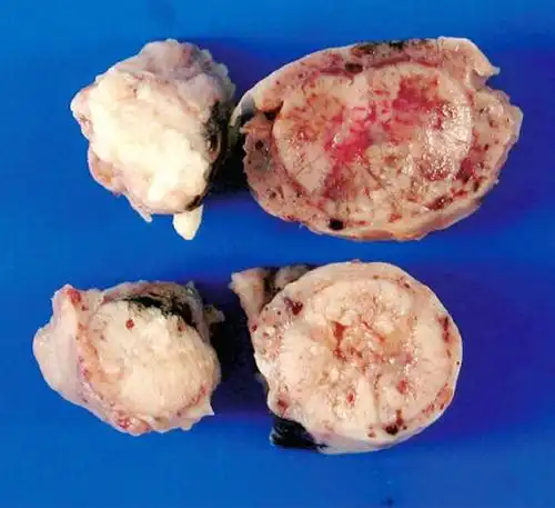 临床诊治思维:原发性脊髓内淋巴瘤