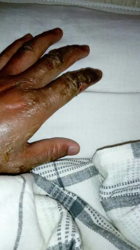 昨天手被电短路烧伤死皮大部分还在可以吹空调吗