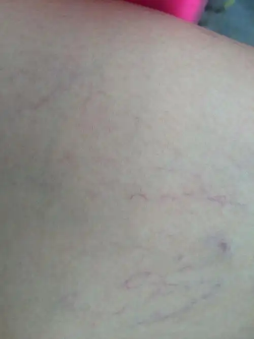 这是什么病,双腿布满了这样的血丝,会死吗