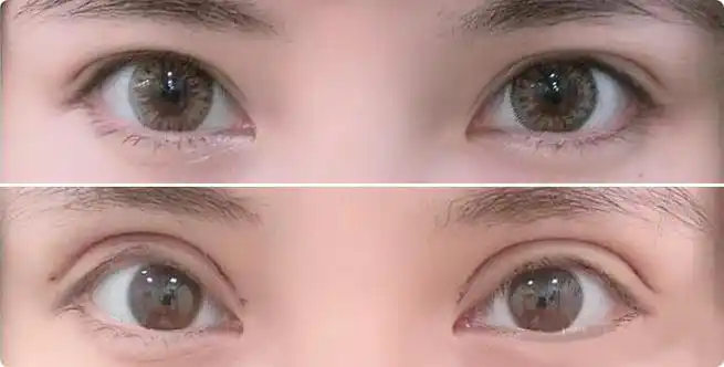 切开双眼皮案例效果对比图