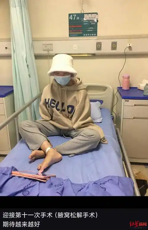 双手截肢全脸毁容23岁烧伤女孩3年12次手术重生我还想变美