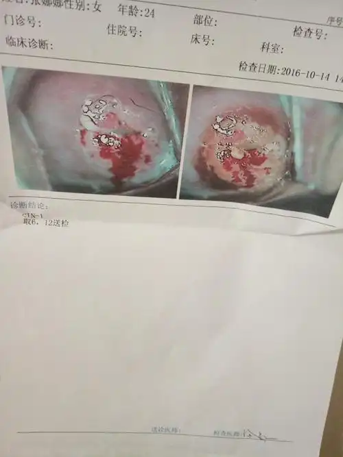 子宫糜烂,吃药能治好吗?