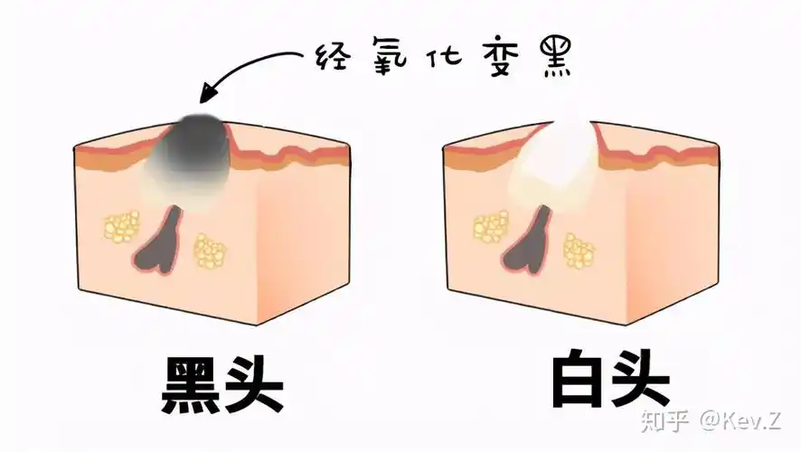 黑头到底是什么