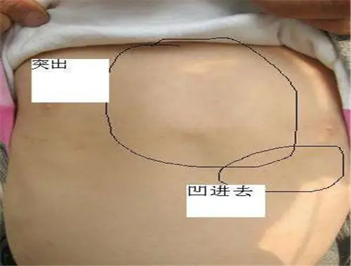 小儿鸡胸图正确对照图_有来医生