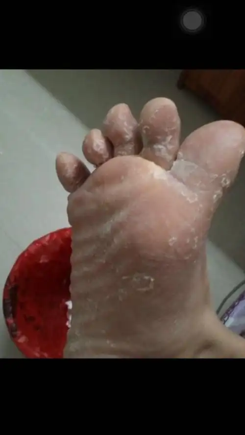 欢迎有脚气 脚臭 脚痒 水泡 脱皮 干裂 糜烂等症状的朋友进来看看.