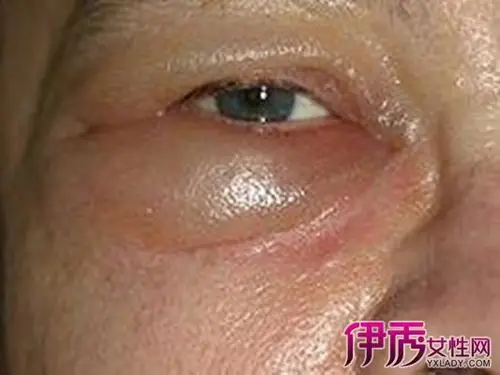 肾炎轻度眼睑水肿图片_轻度肾炎能够自愈吗