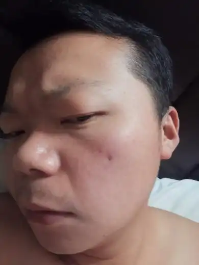 脸上长了个小瘤子怎么办?