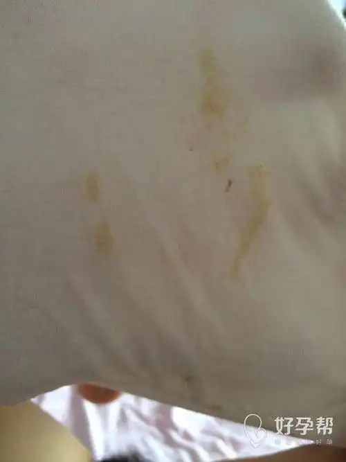 如题,之前见红了两次,打了三周保胎针后来一直内裤上这样,夹杂着白带