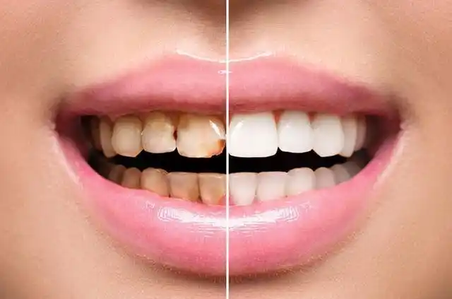 牙齿的色泽往往会影响一个人的仪容,许多人会由于牙齿的色泽选择"笑不