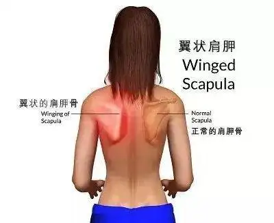 正常来说,肩胛骨应该是贴紧胸壁的,而翼状肩胛则是肩胛骨下角和内侧缘