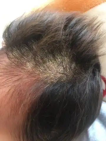 一个多月的宝宝头皮这是什么呀?头皮屑也不像 厚厚的一块