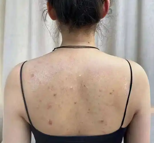 低成本搞定前胸后背痘痘脓包每天十分钟油痘皮秒变奶油肌