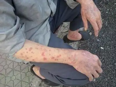 湿毒与皮肤过敏症状怎区分?