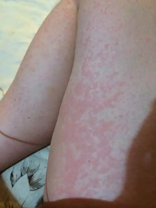 昨天皮肤过敏眼看着由一粒粒蔓延成一片片红的很严重 我就出门走走