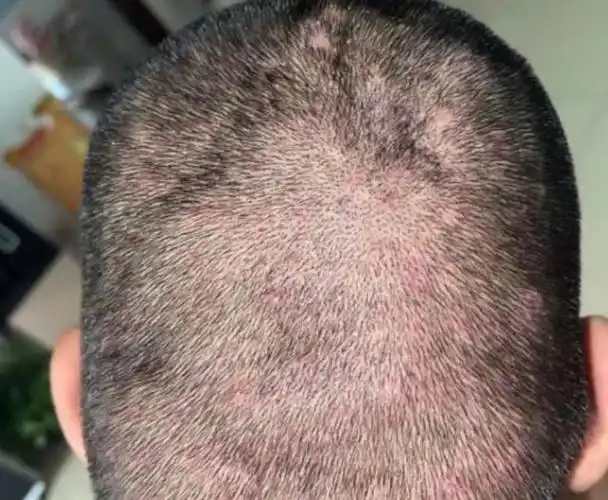 头皮反复出现红疙瘩,有时还会流出脓 水,让你感到又痒又痛.