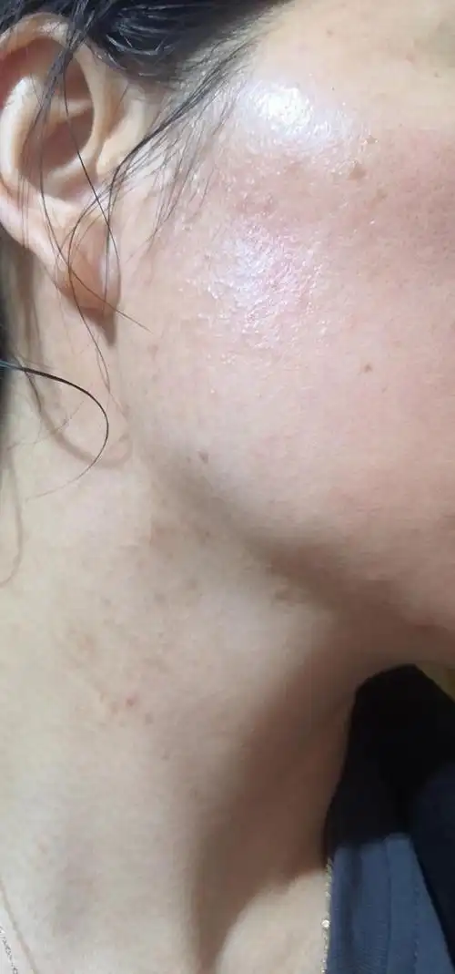 屏障受损长逆光疹怎么办?4个步骤教你避雷