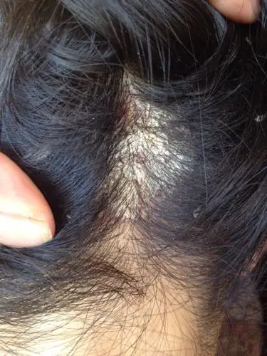 我头上长了一块像头皮藓一样的东西.请帮我看一下,是什么?该怎么治疗?