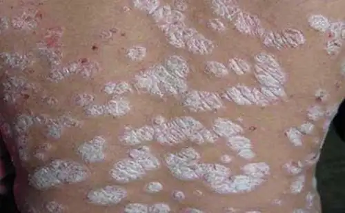 牛皮图片初期症状图片_银屑病求医网