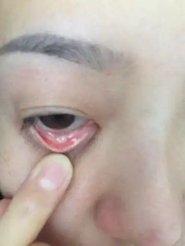 我下眼睑长的是什么啊?