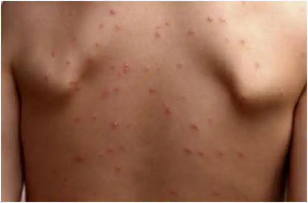 艾滋初期皮疹图片7