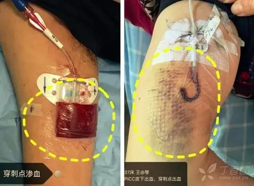 穿刺点渗血,皮下血肿 症状:穿刺点渗血,疼痛,肿胀,皮下瘀斑等.