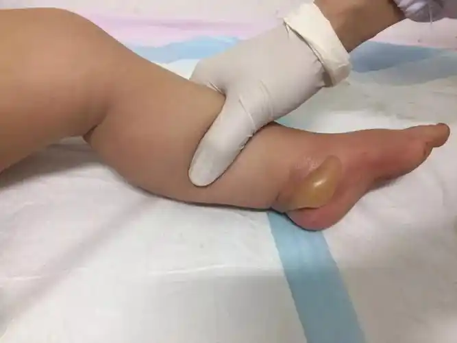 小孩烫伤怎么办