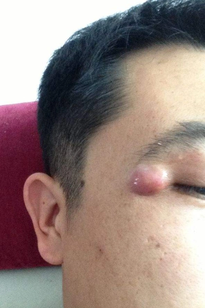 眼角长了个疙瘩图片 (42)