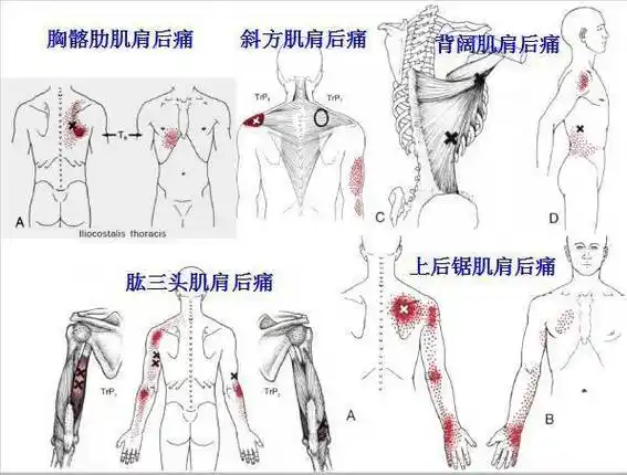 全身激痛点手册