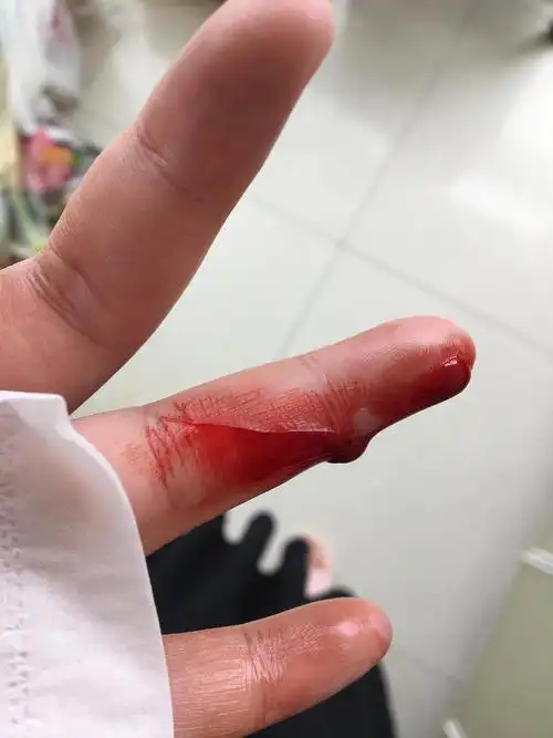 呜呜呜,我今天受伤了…(慎入)