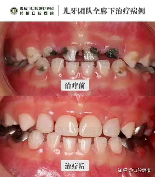 宝妈们一定注意儿童蛀牙更多发生在这颗牙上六龄齿