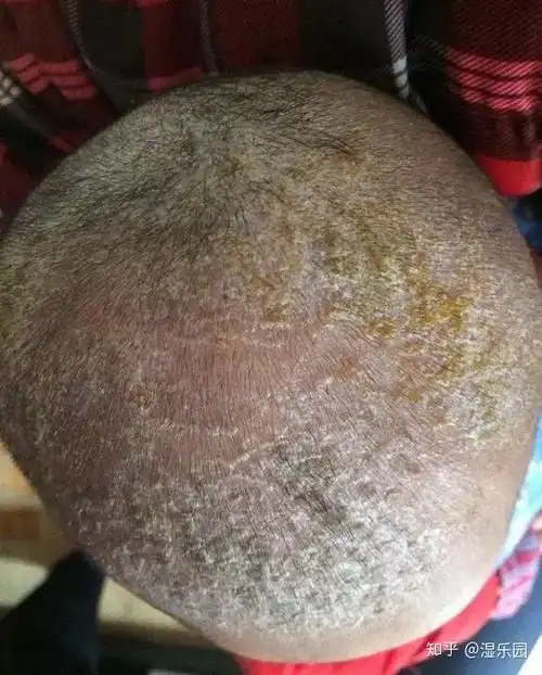 在家给头上长湿疹的宝宝理发,新手妈妈这么做就行了!