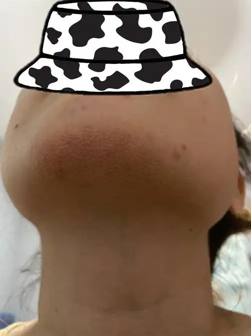 下巴长了像鸡皮疙瘩一样的东西