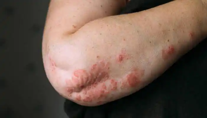 长春肤康医院浅谈:发生这些症状可能是牛皮癣的前兆