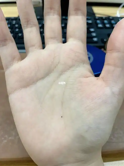 手掌突然涨了个痣有什么讲究吗要不要点掉