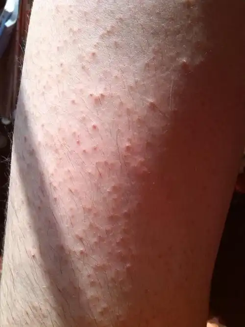 医生好,我的手臂和腿上的毛孔哪里都有好多的这种红色痘痘,已经有很多