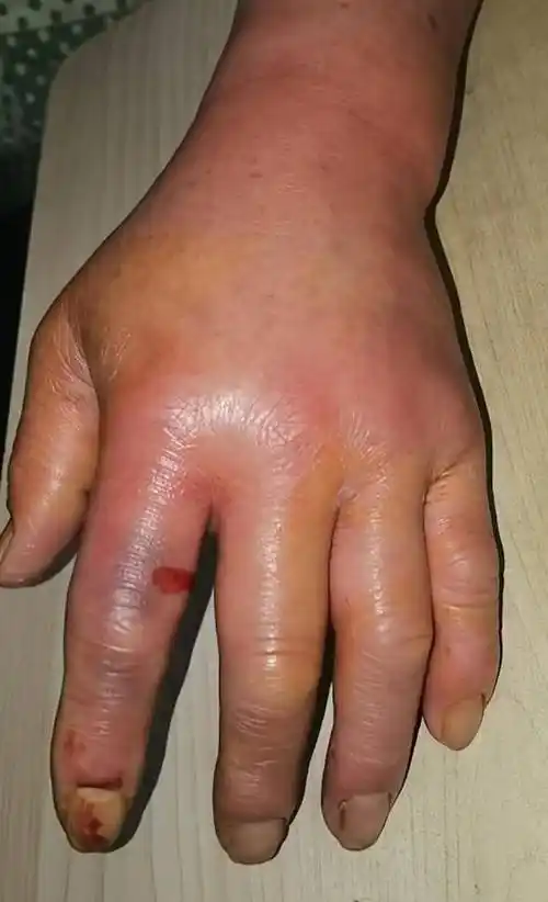 这种菌感染进入好发季,有人曾截肢_温先生_处理_王亮