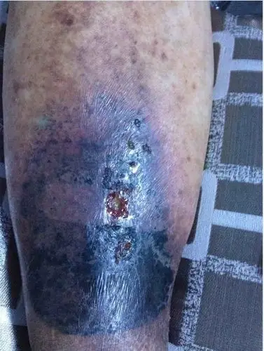 我爷爷小腿溃烂,以前有肝病史…溃烂处发黑,谁知道