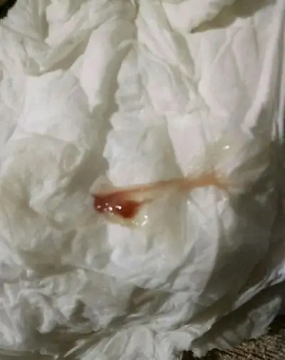 白带带血图片49