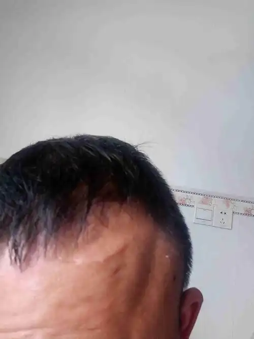 律师您好,交通事故造成我额头上有一个一寸半长的伤