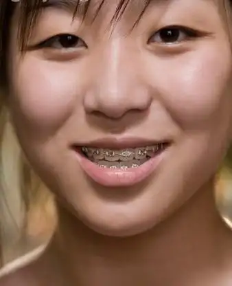 引发地包天的不良习惯