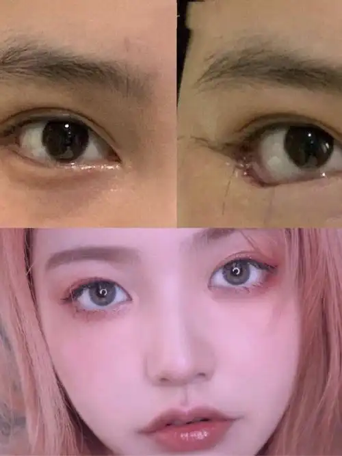 眼睑下至——芭比眼最有效的方法·95什么是芭比眼不是_圈子-新氧