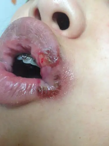 一年前得过一次细菌性痢疾,嘴角跟着一起破了,类似于上火.