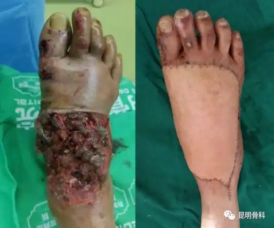 昆骨专家应用皮瓣移植技术为"失足"老汉造"新脚"