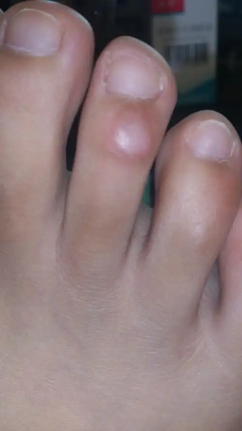 我脚上长了一个肉疙瘩还有厚厚的一层皮,有三年了吧,不疼,有时候我