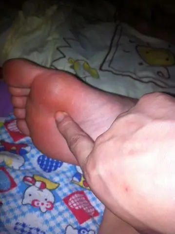 脚底痛,好苦恼,一直困扰我的生活,跪求各路大仙帮忙