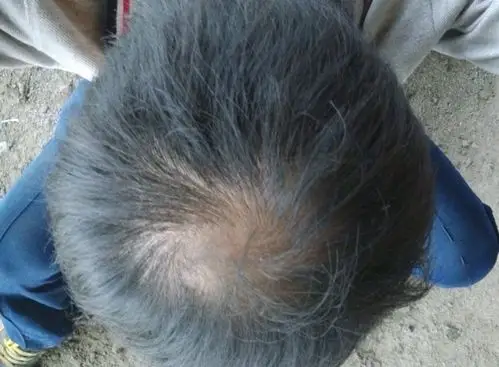 什么原因导致的男性脱发