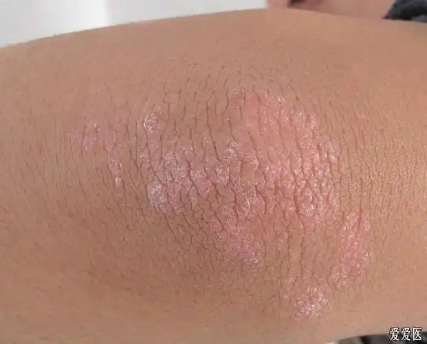 双肘部皮疹一年