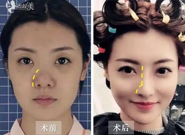 荔枝美:西安艺星医疗美容医院王志bsk鼻综合术前术后对比照