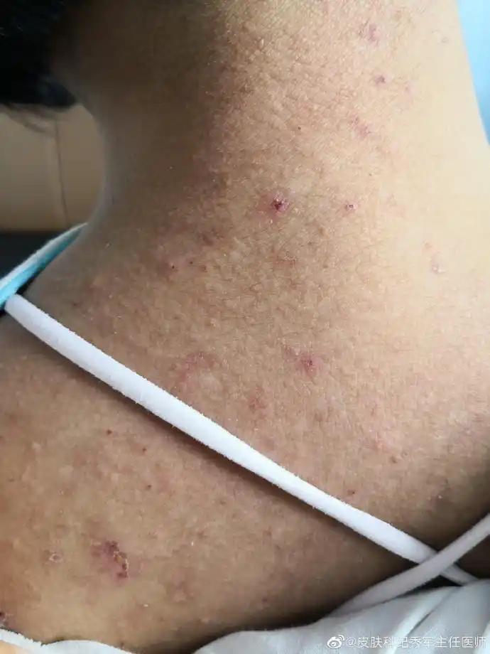 背部糠秕孢子菌毛囊炎.#皮肤问题管理##医生医事#2莱芜