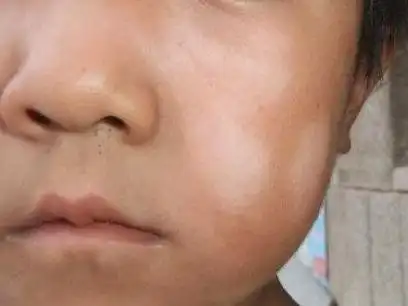 宝宝脸上的白斑是"虫斑"?虫说:这个"黑锅"我不背